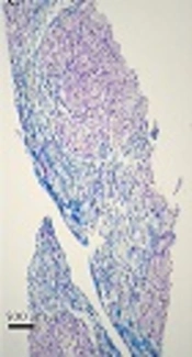 Histopathological Findings in Cholesteryl Ester Storage Disease: A Report of Three Cases